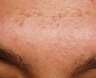 Acne mechanica - akne na čelu