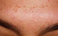 Acne mechanica so posledica iritacije kože