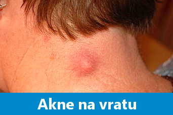 Mozolji na vratu