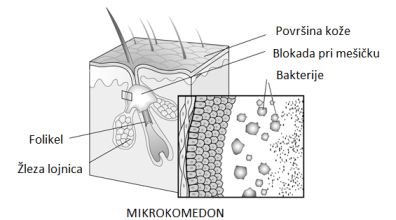Mikrokomedon Mikrokomedon je prva stopnja razvoja akne