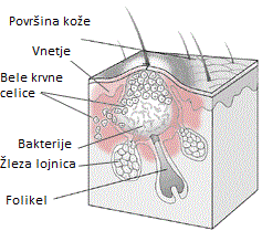 Pustula Pustula